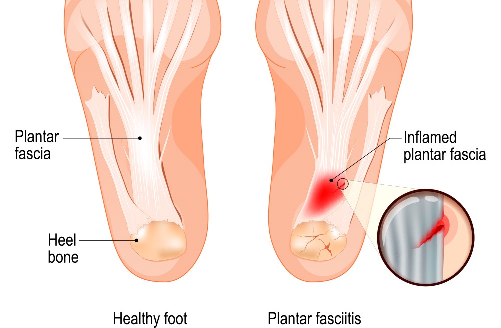 Symptoms and cause of Plantar Fasciitis