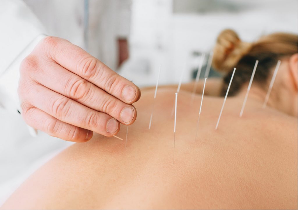 dry needling therapy
