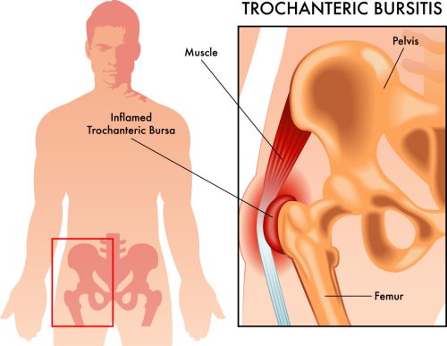 Trochanteric Bursitis Condition