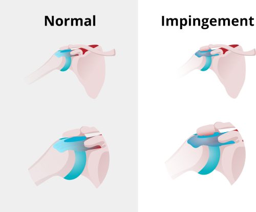 shoulder-impingement